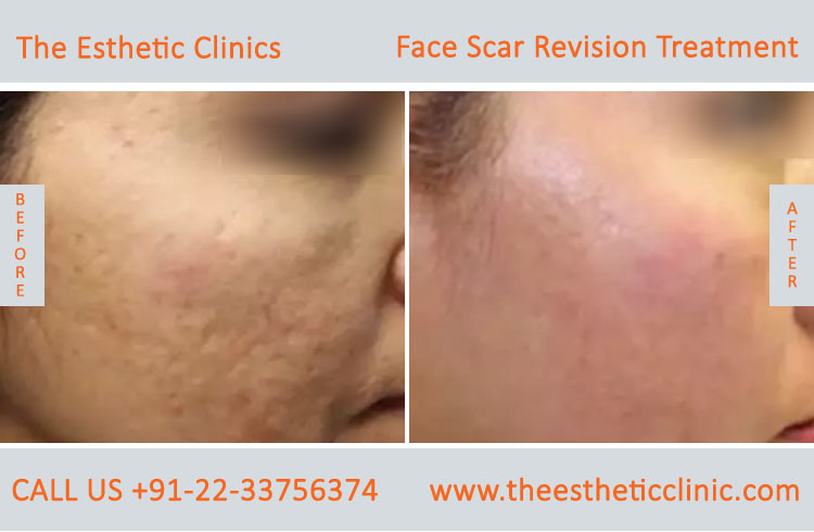 Facial Scars Revision laser Treatment for Face before after photos in mumbai india (3)
